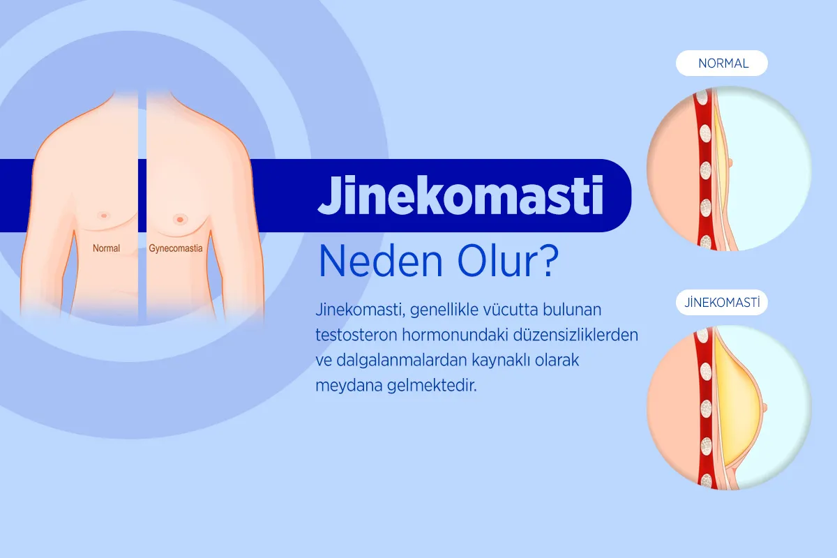 Jinekomasti 1 Jinekomasti Çeşitleri
