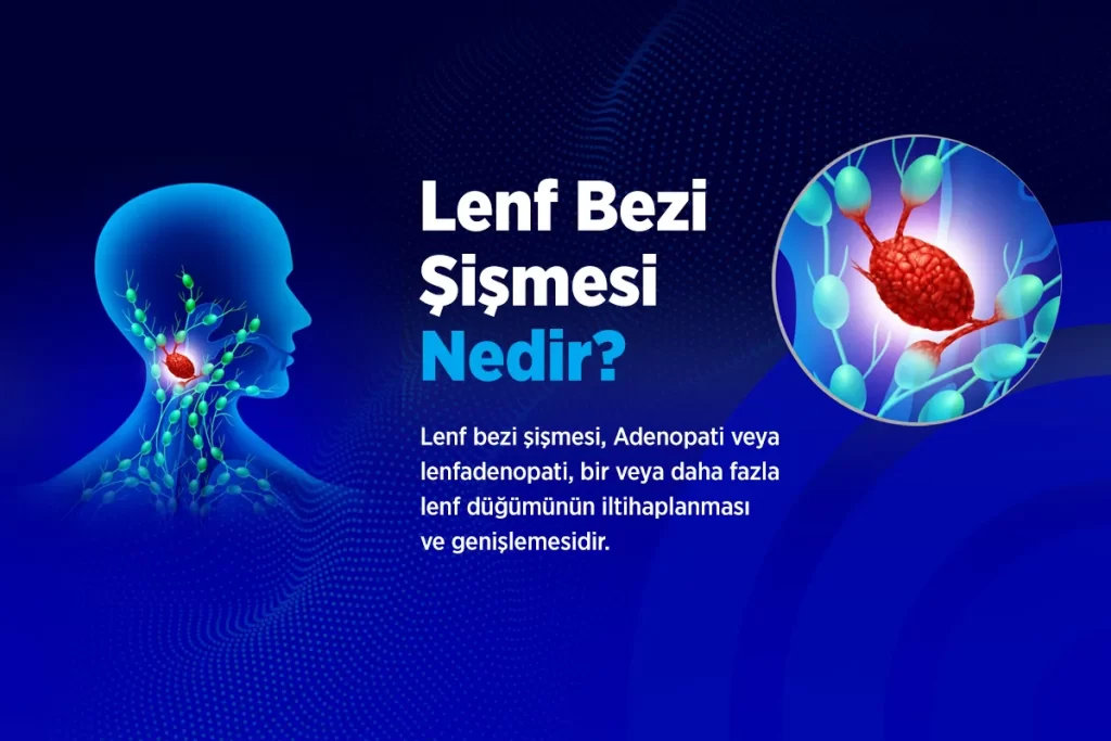 Lenf Bezi Şişme Belirtileri