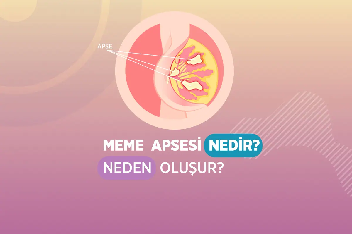 Memede Apse Boşaltılması 1 meme apsesi nedir neden olusur