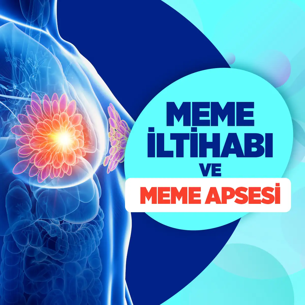 Mastit 2 meme iltihabi apsesi